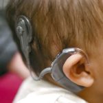 DiversifiedHearing-benefits-cochlear-implants-ny